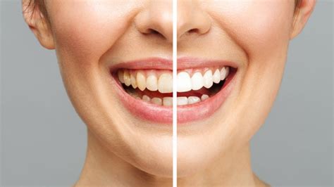 Tooth Discoloration Dentist In Ballincollig Guiney Dental