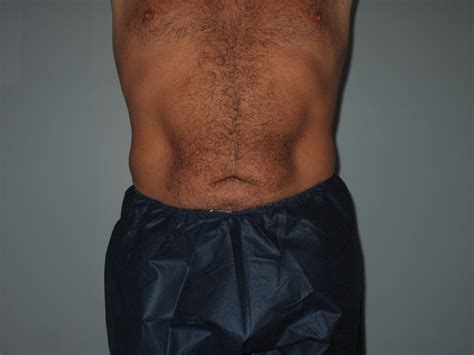 Liposuction Before And After Photos Laser Lipo And Vein Center