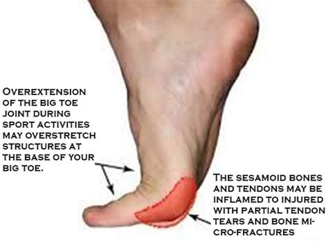Big Toe Joint Conditions Ottawa Foot Clinic