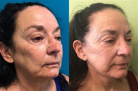 Eyelid Surgery Before And After Photos Patient 274 San Francisco Ca