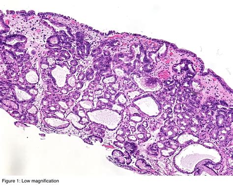 Pathology Outlines Fundic Gland Polyp