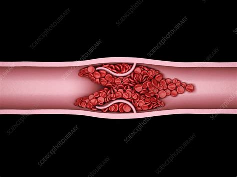 Blood Clot Illustration Stock Image C0487120 Science Photo Library