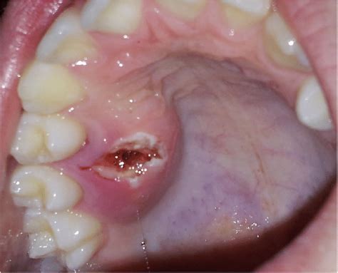 Palatal Swelling Post Biopsy Between Upper Right First And Second