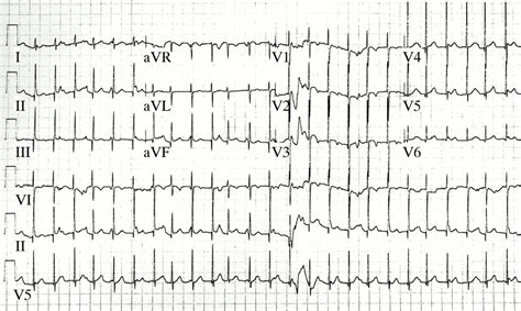 Congenital Junctional Ectopic Tachycardia In Children And Adolescents