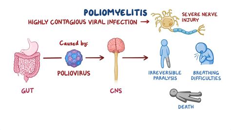 Poliomyelitis Nursing Osmosis Video Library
