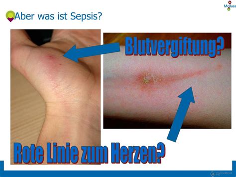 Aug 25, 2016 · häufigstes anzeichen sind plötzlich eintretende, starke blutungen aus der scheide. PPT - Sepsis erkennen, initiale Diagnostik und Therapie ...