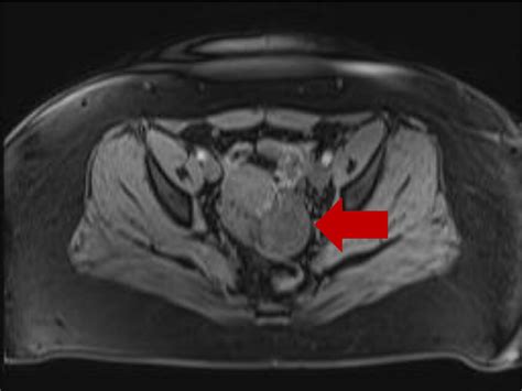 Mri Of The Pelvis Axial T1 Weigthed Image Demonstrates A Minimally