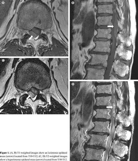 Figure 1 From Spontaneous Spinal Epidural Hematoma Caused By Dual