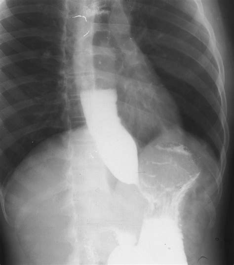 Achalasia Cardia Barium Swallow Sumers Radiology Blog