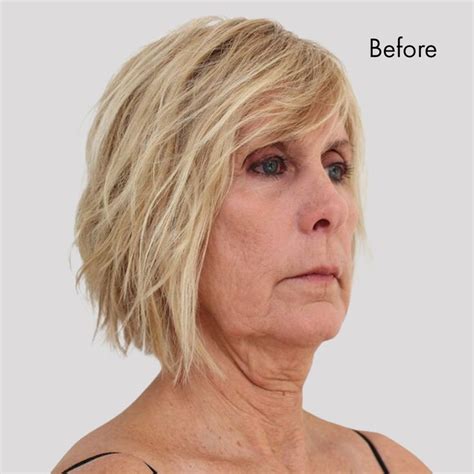 Instant Neck Lift In 2021 Neck Lift Instant Face Lift Hairstyle
