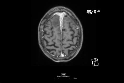 Idiopathic Hypertrophic Pachymeningitis Pacs