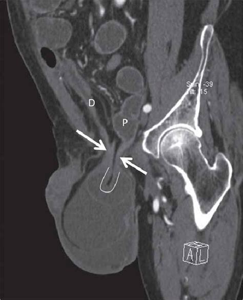 Closed Loop Obstruction Secondary To A Left Inguinal Hernia In A