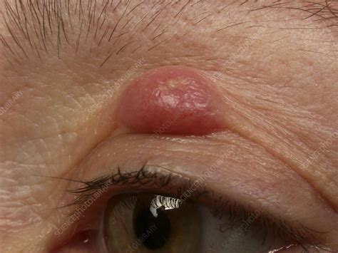 Eyelid Cyst Stock Image C0064006 Science Photo Library