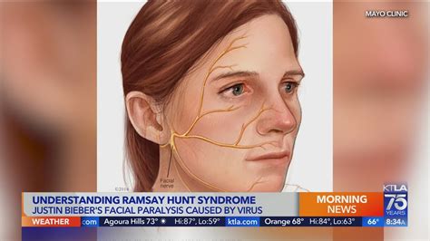 What Is Ramsay Hunt Syndrome Youtube