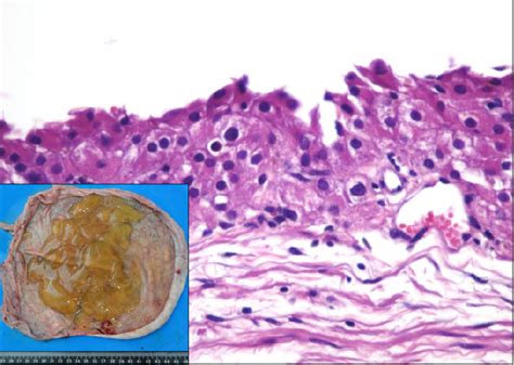Figure 1 From Giant Luteinized Follicular Cyst Of Pregnancy Semantic