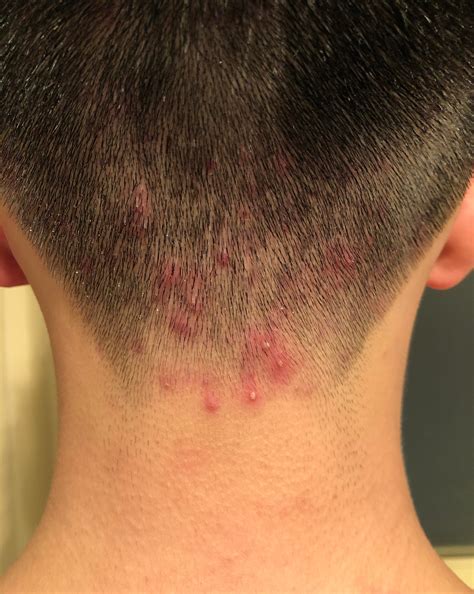 Is This Folliculitis Also Does Anyone Have Any Recommendations On