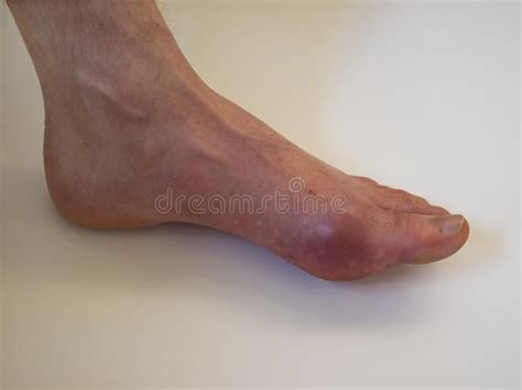 Foot Disease Rheumatism And Gout Red Leg Swelling Pain In The Foot