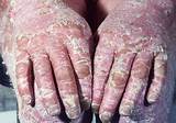 Images of Is There A Treatment For Psoriasis