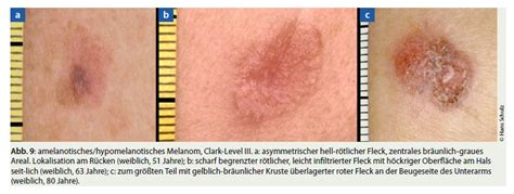 Hautkrebs Hautarztpraxis Dr Med Detlef Schulz