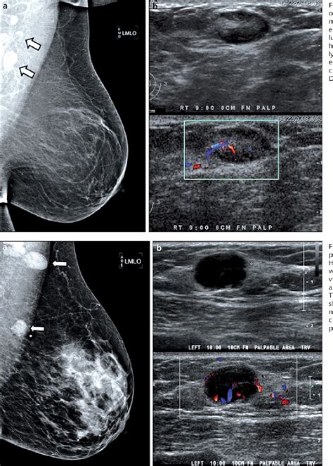 Figure 1 From Abnormal Axillary Lymph Nodes On Negative Mammograms