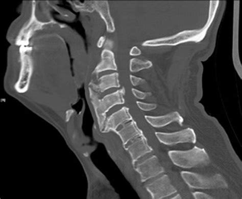 The Preoperative Ct Scan Of The Cervical Spine Reveals