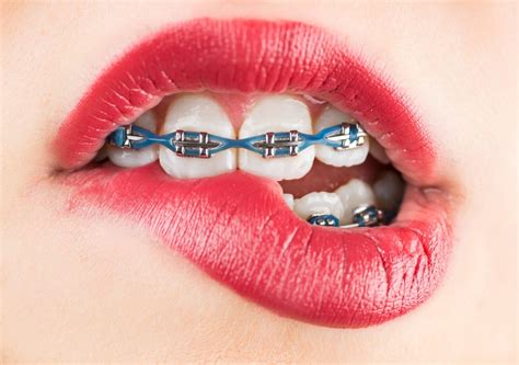 Best Braces Colors For Adults Which One Is You
