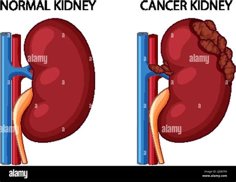 Normal Kidney And Cancer Kidney Illustration Stock Vector Image And Art