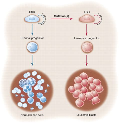 Leukemia Cells Vs Normal Cells