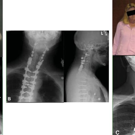 A A 54 Year Old Woman With Cervicothoracic Scoliosis And Torticollis