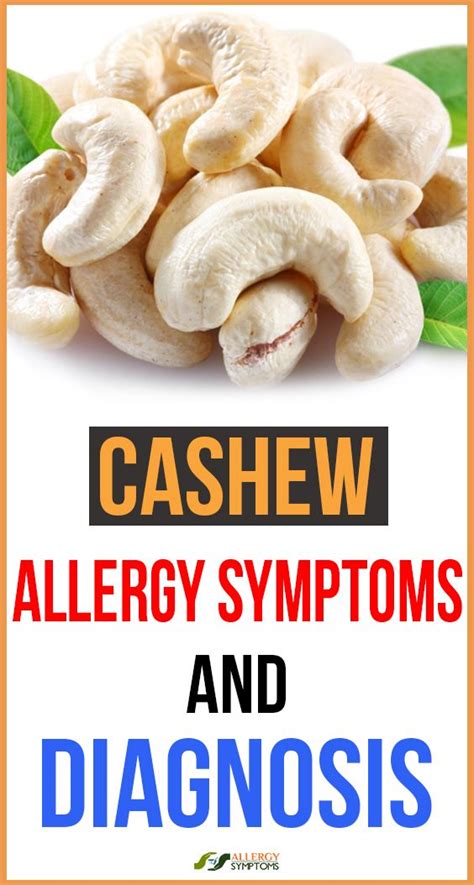 Cashew Allergy Symptoms And Diagnosis Cashew Allergy Allergy