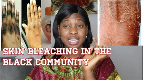 Is This Why Black Women Bleach Their Skin Skin Bleaching Youtube