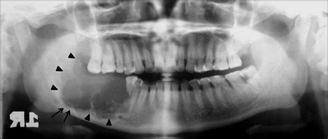 A Panoramic Radiograph Displays A Well Defined Multilocular