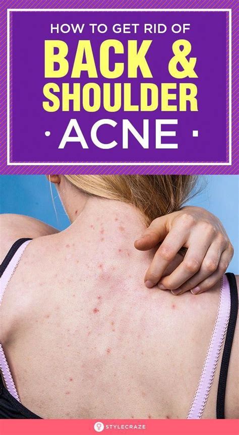 How To Get Rid Of Back And Shoulder Acne Fast Back And Shoulder Acne