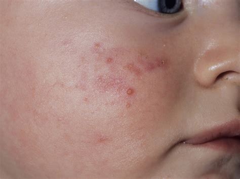 Childhood Rashes Skin Conditions And Infections Photos Babycentre Uk