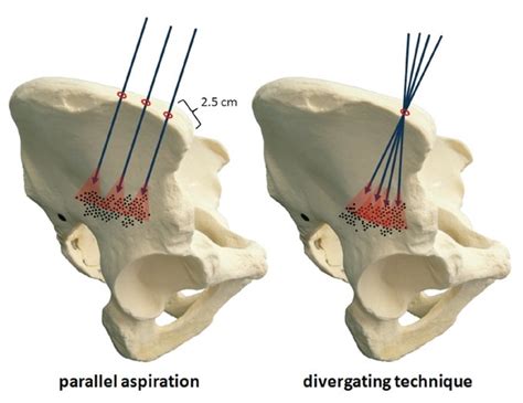 The Areas Of The Iliac Crest Reached By The Tip Of The Aspiration