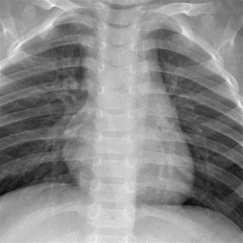 Chest Xrays Bacterial Viral Pneumonia Normal Kaggle