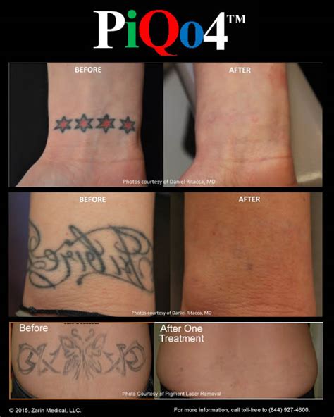 Pain and side effects of laser tattoo removal. Tattoo Removal with Less Pain, 40% Fewer Treatments and ...