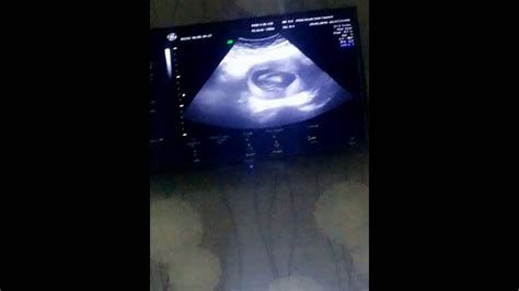 Usg Bayi Dikehamilan 3 Bulan 14 Minggu Youtube