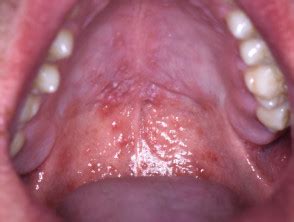 Mouth can be very much complicated especially when it comes to the issues to do with the hard palate. Little Red Dots On Roof Of Mouth Sore Throat - Latest Rooftop Ideas