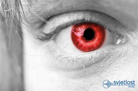 Medical Importance Of Red Eyes Effect In The Photos