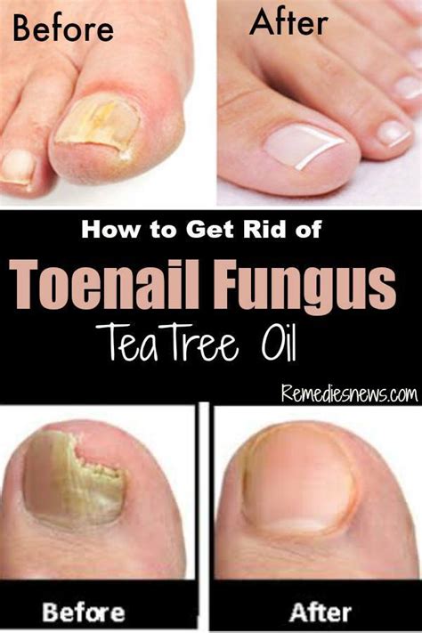 How To Get Rid Of Toenail Fungus Before And After With Tea Tree Oil