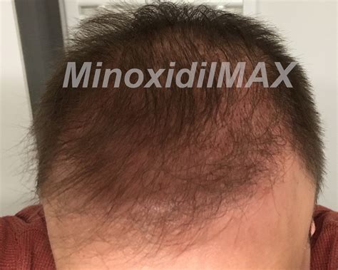 Minoxidil With Finasteride Topical Solution Dualgen 15 With