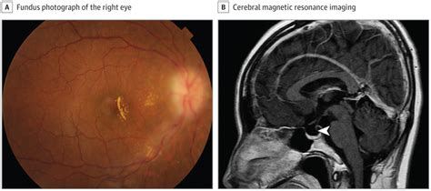 Bilateral Papilledema And Partially Empty Sella In A Woman In Her 30s