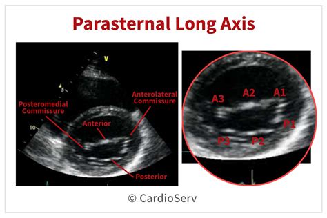 Parasternal Short Axis View Psax Mitral Valve Scallops Echo Mitral