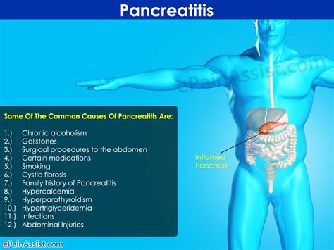 What Is Pancreatitistreatmentsymptomscausesdiethome Remedies