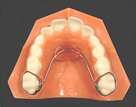 The Nance Appliance Is Used To Keep The Upper Molars Back And To Keep