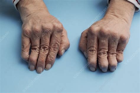 Hands With Rheumatoid Arthritis Stock Image C0095324 Science