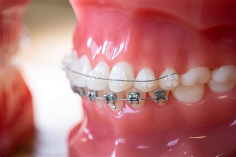 Clear Braces For Discreet Treatment Mbrace Orthodontics In Falmouth Me