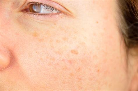 Mole Vs Freckle 10 Ways To Tell The Difference