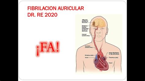 fibrilacion auricular enarm youtube